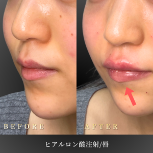 20代 唇ヒアルロン酸 症例写真〔左45度Before/After〕｜大阪 心斎橋BiBiクリニック