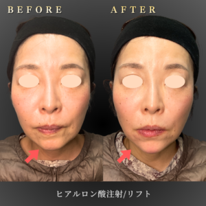 50代 リフトヒアルロン酸 症例写真〔正面Before/After〕｜大阪 心斎橋BiBiクリニック
