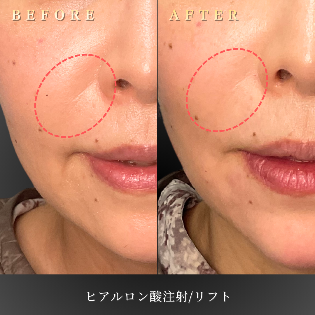 50代女性のヒアルロン酸リフト施術前後の別角度比較