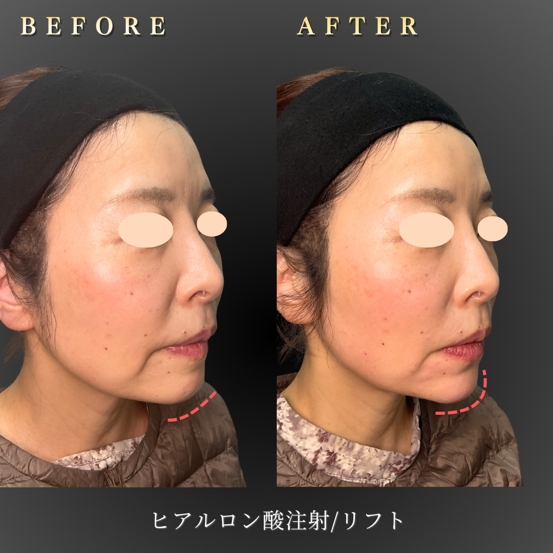 50代女性のヒアルロン酸リフト施術前後の側面写真