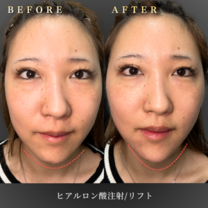 50代 リフトヒアルロン酸 症例写真〔正面Before/After〕｜大阪 心斎橋BiBiクリニック