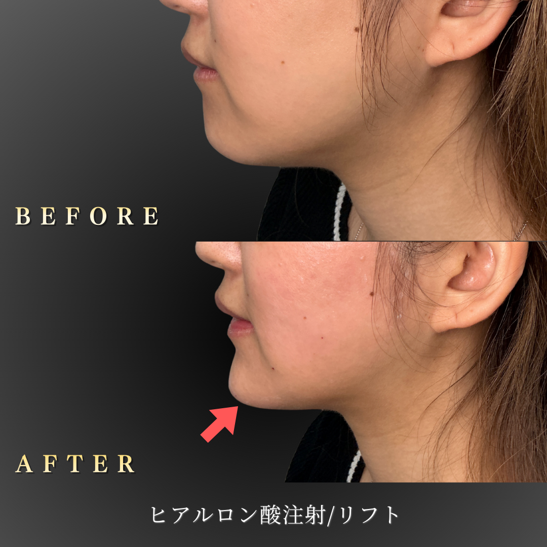 30代女性のヒアルロン酸リフト施術前後の側面比較写真