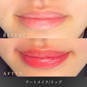 20代 リップアートメイク 症例写真〔左45度Before/After〕｜大阪 心斎橋BiBiクリニック