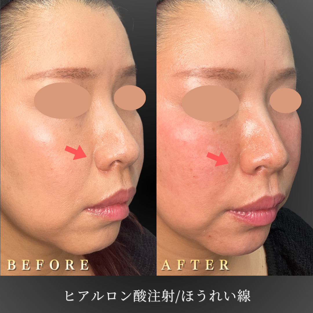 40代女性の右45度ほうれい線改善のBefore/After写真