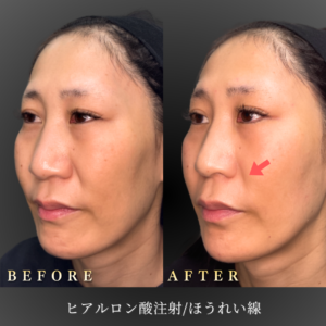 40代ほうれい線ヒアルロン酸 症例写真〔左45度Before_After〕｜大阪 心斎橋BiBiクリニック