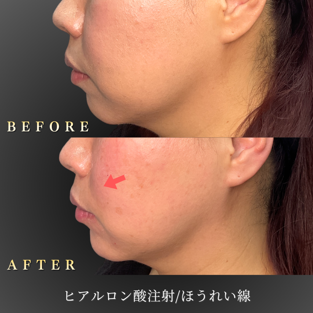40代女性の左横顔ほうれい線改善のBefore/After写真