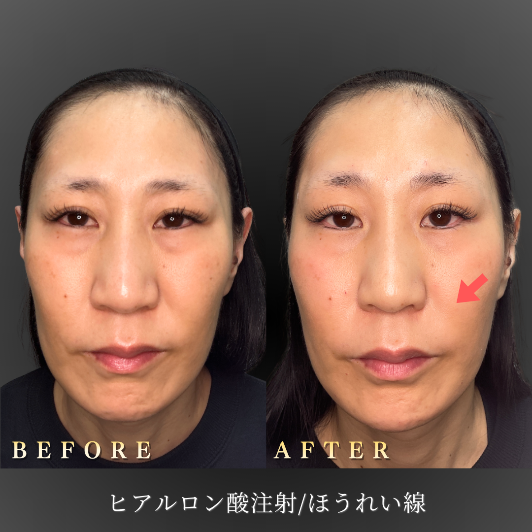 40代女性のほうれい線ヒアルロン酸注入症例写真（正面）