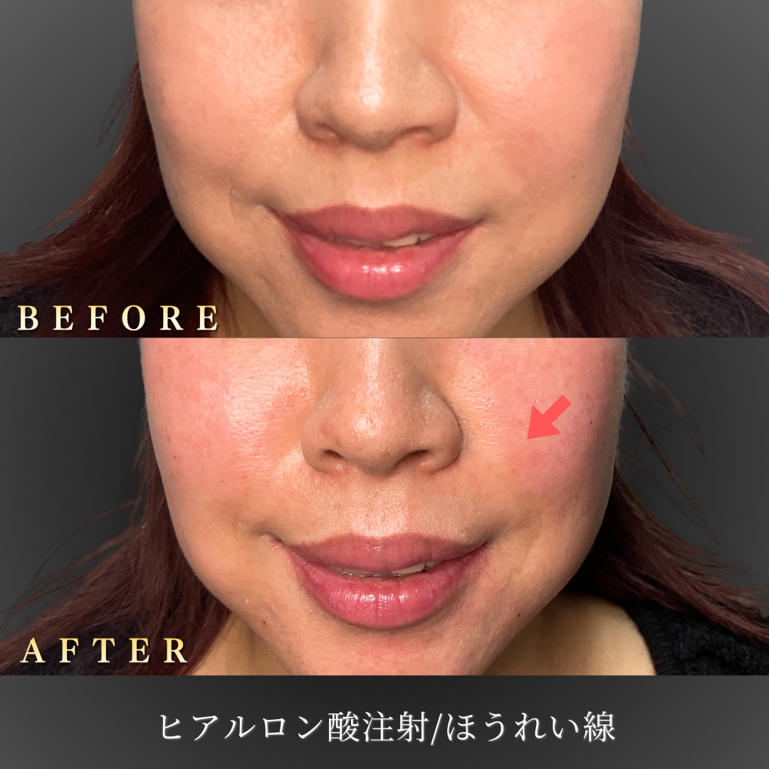 【40代女性】老け見えを改善するほうれい線ヒアルロン酸症例｜大阪 心斎橋BiBiクリニックの症例写真