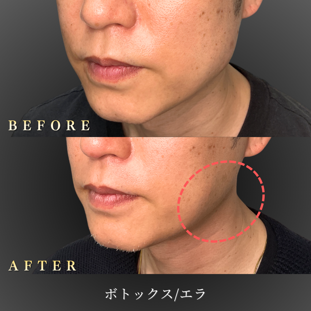 40代男性エラボトックス症例 左側面