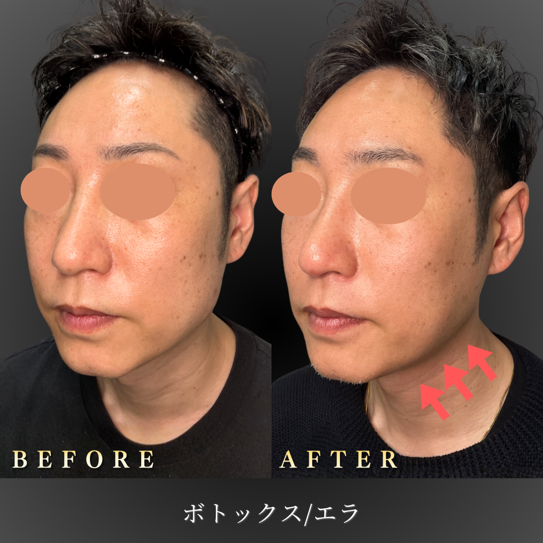 40代男性エラボトックス症例 左45度