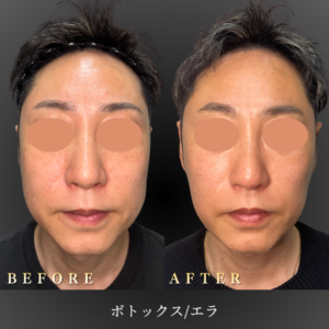 40代男性 顎ボトックス 症例写真〔正面Before_After〕｜大阪 心斎橋BiBiクリニック