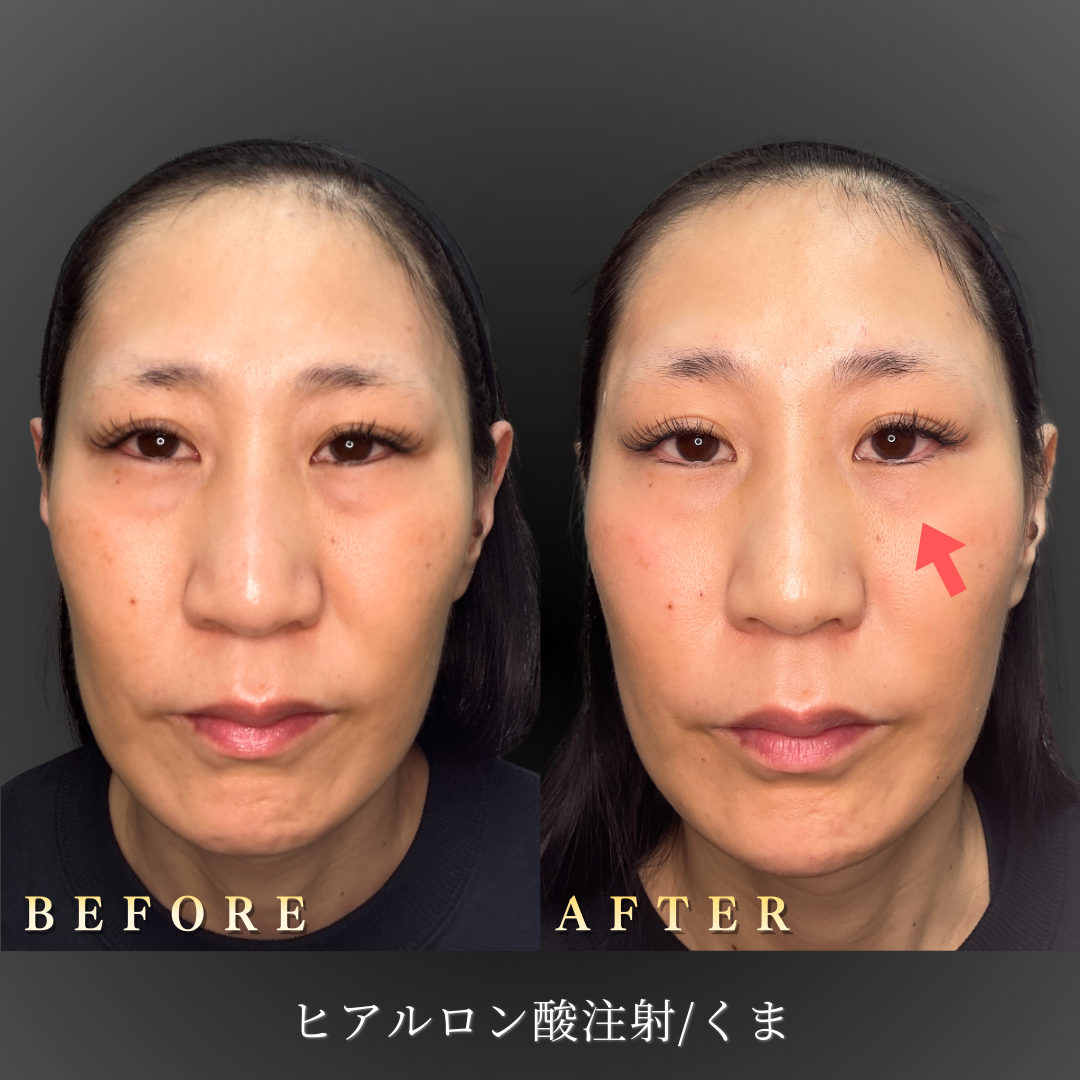 40代女性の目の下の影とたるみ改善症例、正面のBefore/After写真