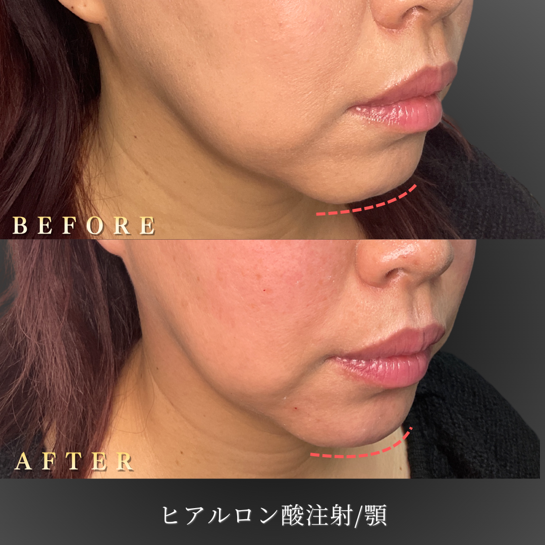 40代女性の顎ヒアルロン酸注入の右斜めからのBefore/After写真