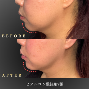 40代顎ヒアルロン酸 症例写真〔左横Before_After〕｜大阪 心斎橋BiBiクリニック