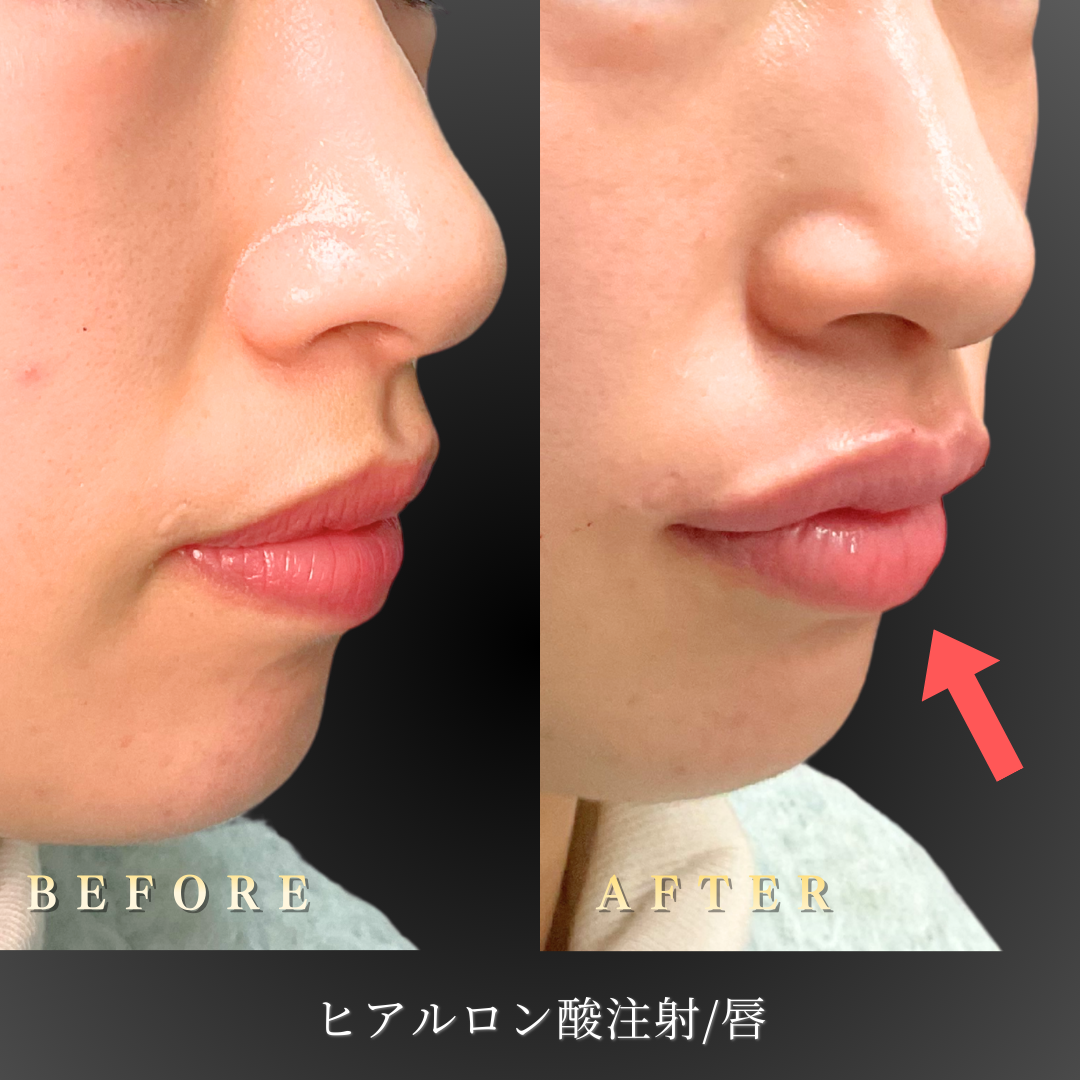 20代女性の唇ヒアルロン酸施術後の正面写真