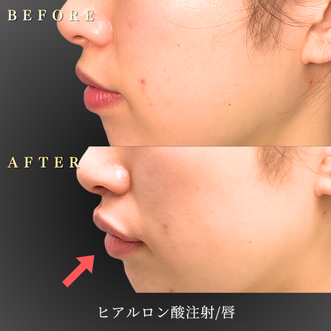 20代女性の唇ヒアルロン酸施術前の正面写真