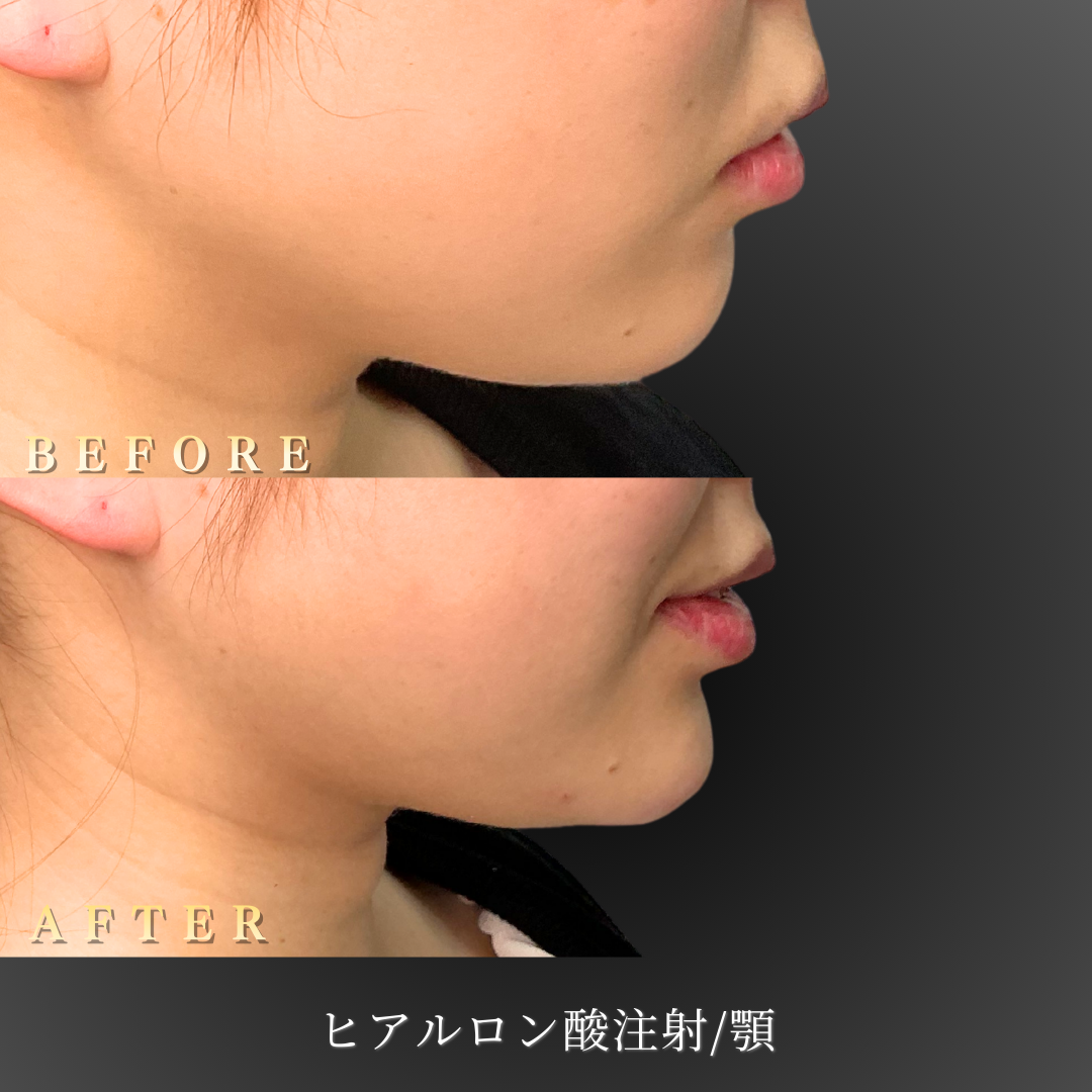 【20代女性】顎ラインをなだらかに整えるヒアルロン酸症例｜大阪 心斎橋BiBiクリニックの症例写真