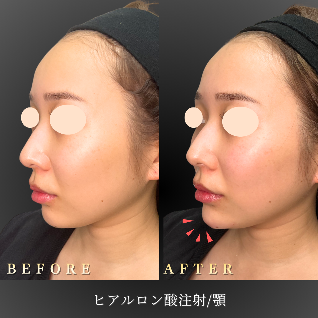 20代女性の顎の施術前後比較写真