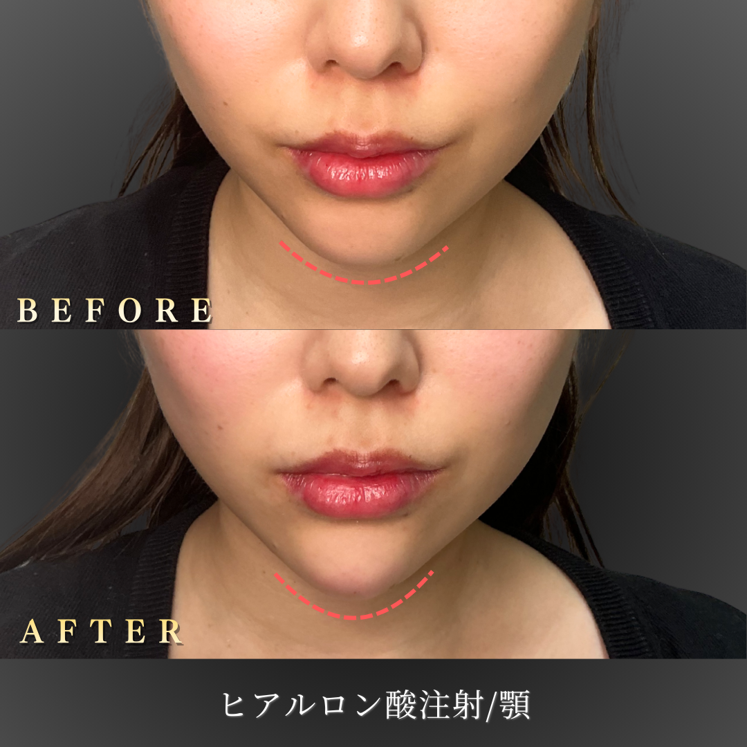 20代女性の顎ヒアルロン酸施術前後の横顔写真