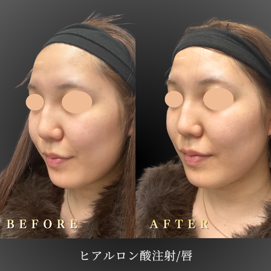 リップヒアルロン酸後の正面写真
