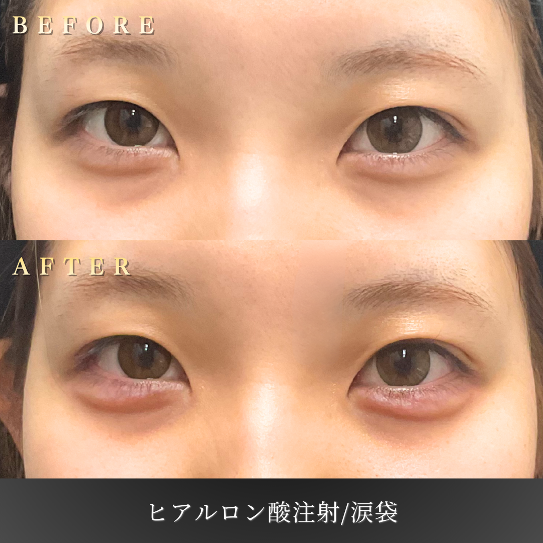 20代女性の涙袋ヒアルロン酸施術前の目元の状態