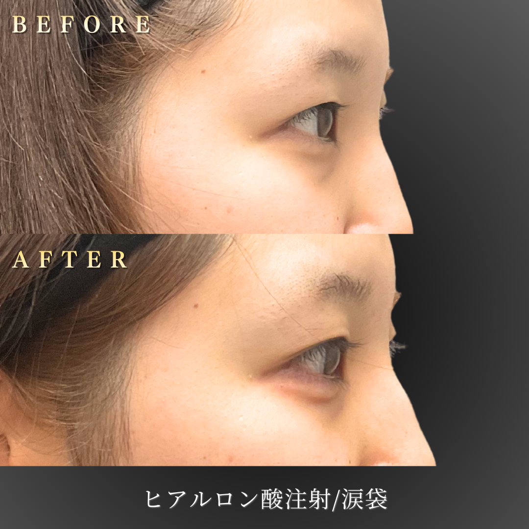 20代女性の涙袋ヒアルロン酸施術後の笑顔時の自然な仕上がり