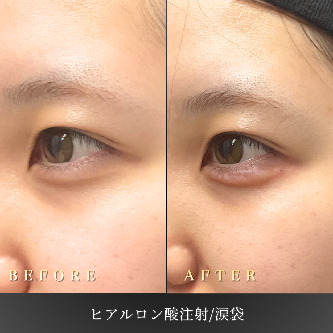 【20代女性】笑顔に立体感を出す涙袋ヒアルロン酸症例｜大阪 心斎橋BiBiクリニックの症例写真