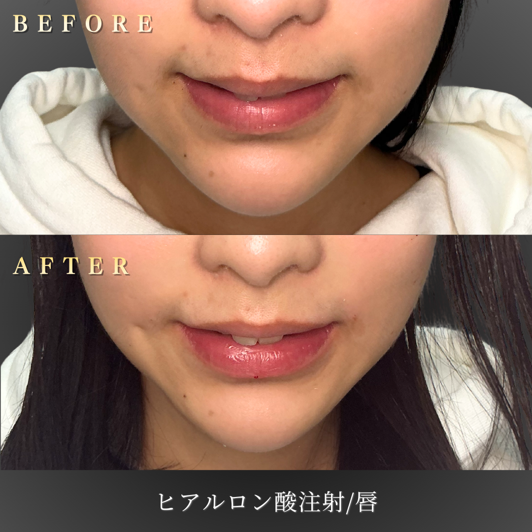 20代女性のリップヒアルロン酸After写真