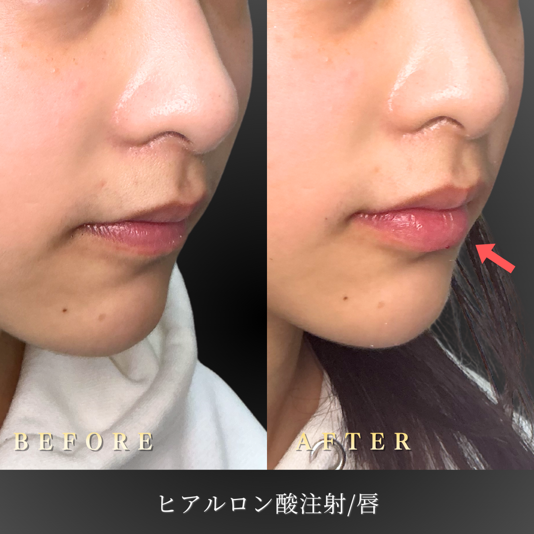 【20代女性】口元全体のバランスを整えるリップヒアルロン酸症例｜大阪 心斎橋BiBiクリニックの症例写真