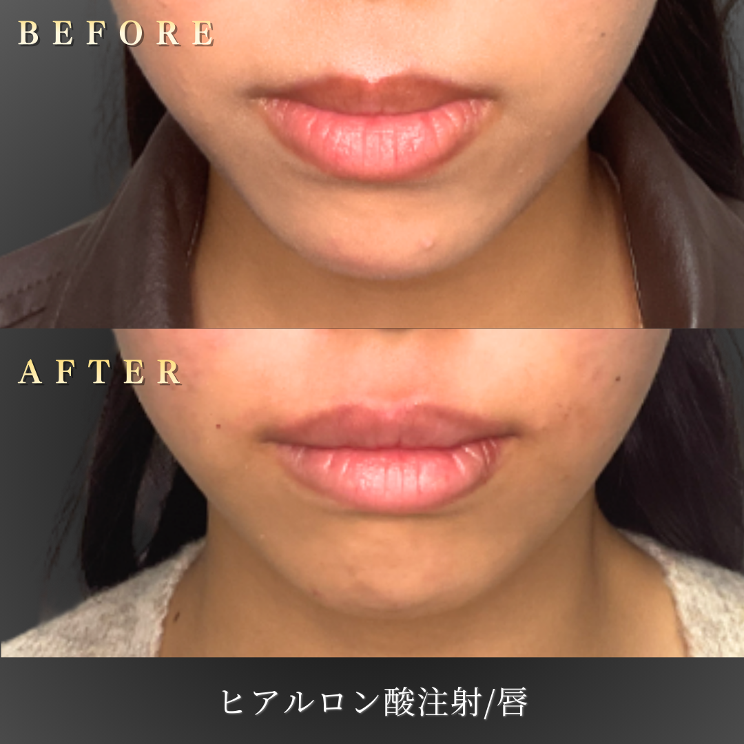 20代女性の横顔のビフォーアフター写真