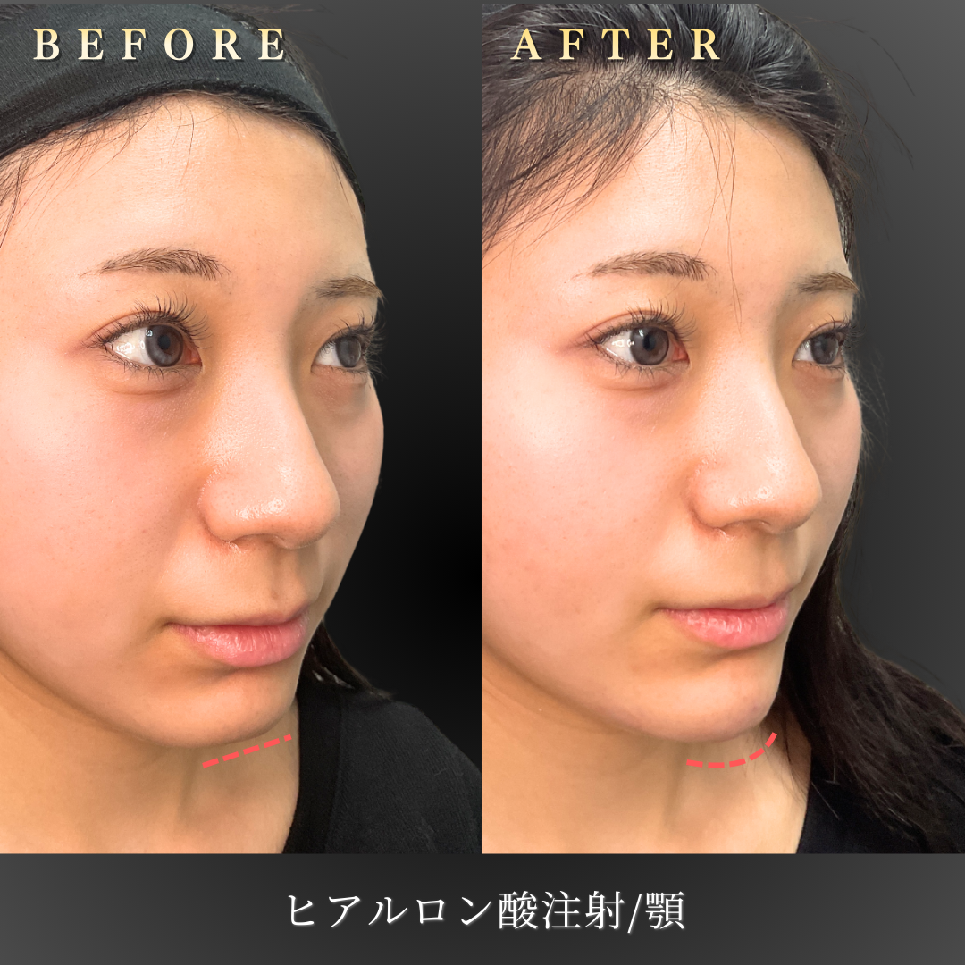 20代女性の顎ヒアルロン酸施術後の横顔写真