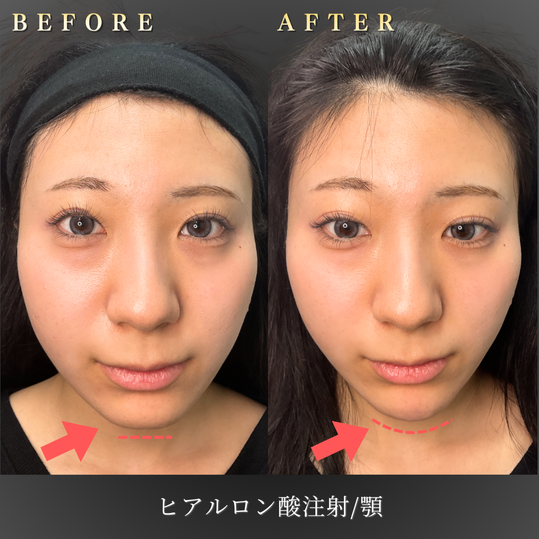 【20代女性】控えめに整える顎ヒアルロン酸症例｜大阪 心斎橋BiBiクリニックの症例写真