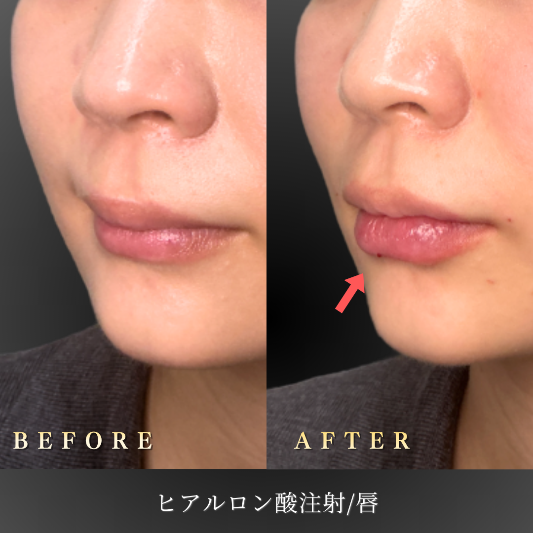 【20代女性】口角を下げずに整えるリップヒアルロン酸症例｜大阪 心斎橋BiBiクリニックの症例写真