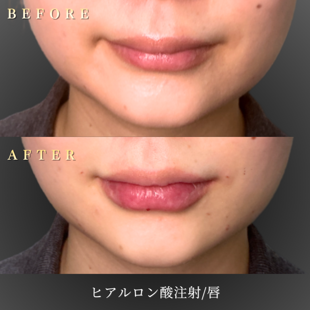 20代女性の唇の施術前の状態