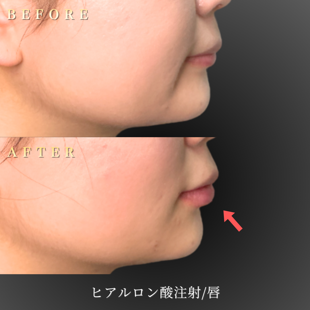 20代女性の唇ヒアルロン酸治療のBefore/After側面写真