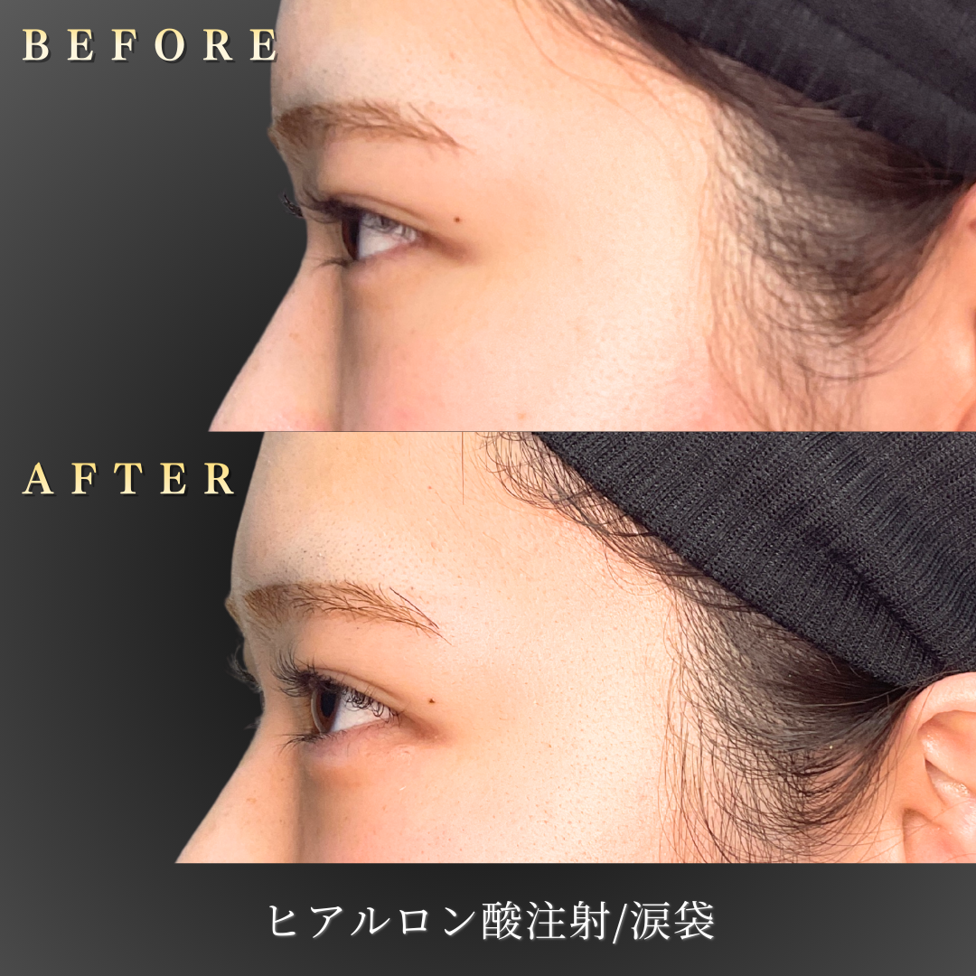 20代女性の涙袋ヒアルロン酸施術後の正面笑顔写真