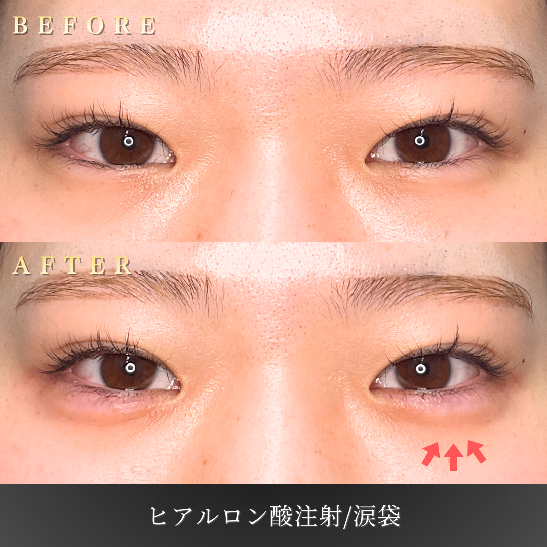 【20代女性】優しい印象を作る涙袋ヒアルロン酸症例｜大阪 心斎橋BiBiクリニックの症例写真