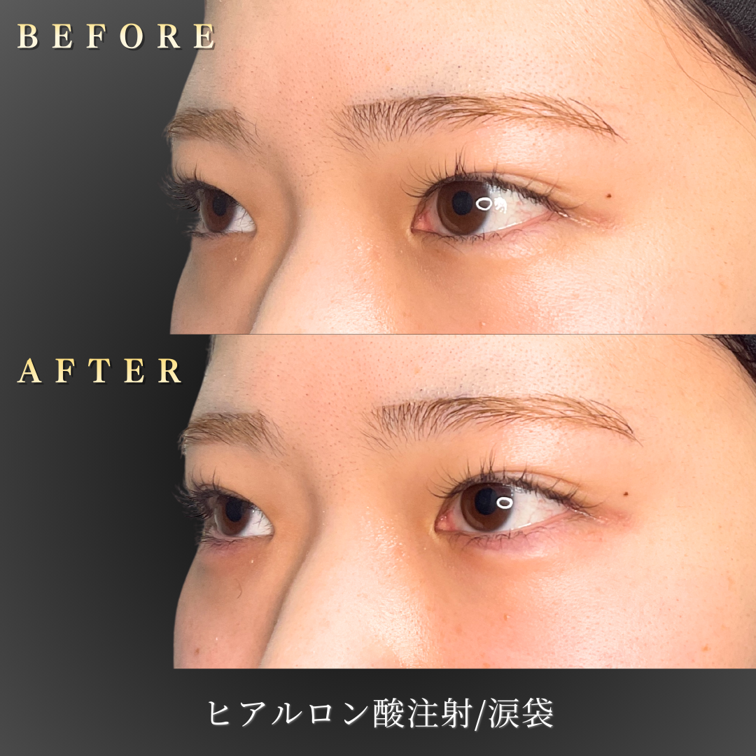 20代女性の涙袋ヒアルロン酸施術前の正面写真