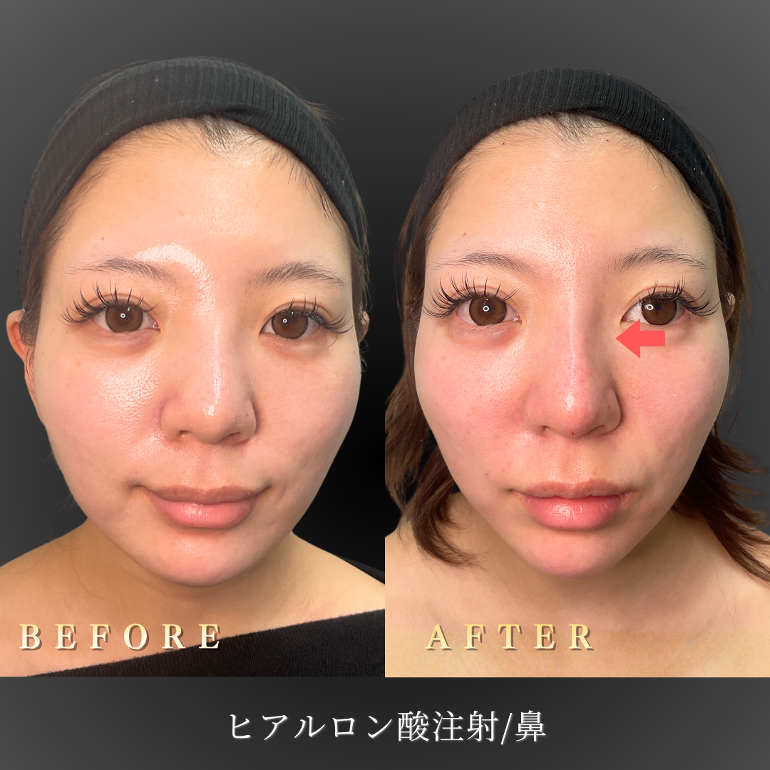 20代女性のエラボトックス Before/After側面写真