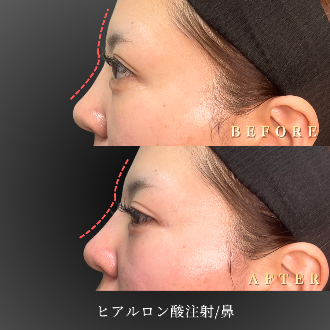 【20代女性】エラ・肩・脇・額 多部位ボトックス症例｜大阪 心斎橋BiBiクリニックの症例写真