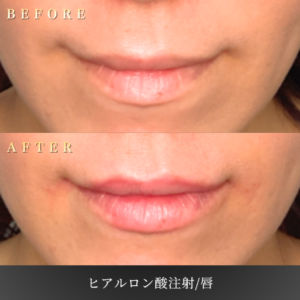 40代 唇ヒアルロン酸 症例写真〔正面Before/After〕｜大阪 心斎橋BiBiクリニック