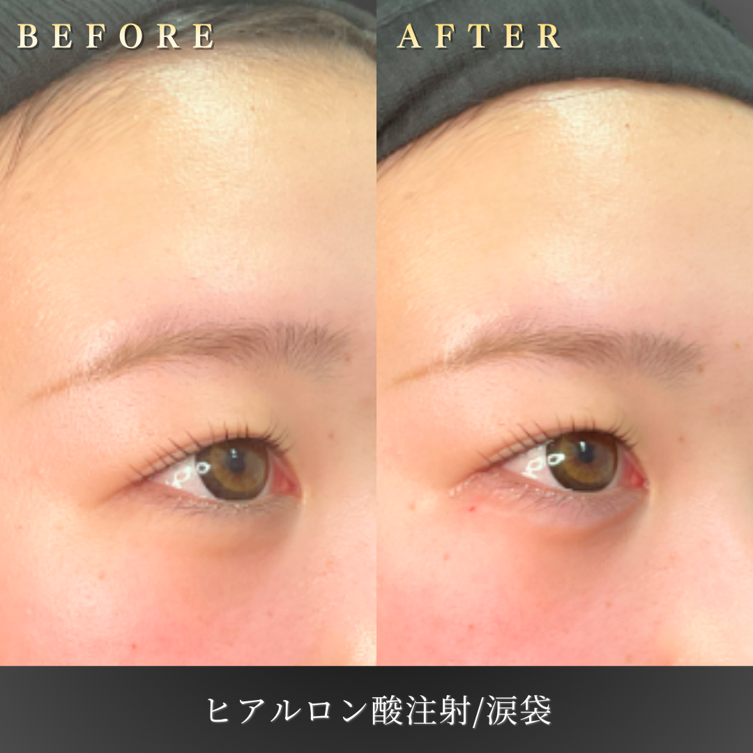 10代女性の涙袋ヒアルロン酸施術 ビフォーアフターサブカット」