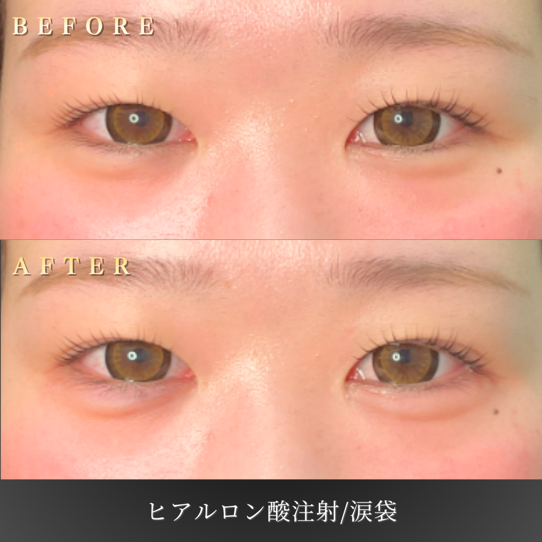 【10代女性】笑顔が可愛く見える涙袋ヒアルロン酸症例｜大阪 心斎橋BiBiクリニックの症例写真