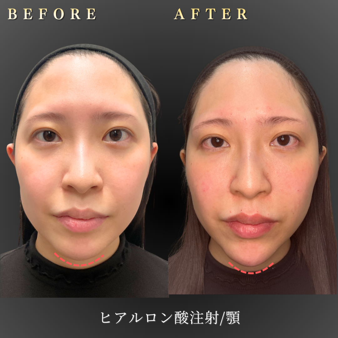 30代女性の顎の悩み Before写真