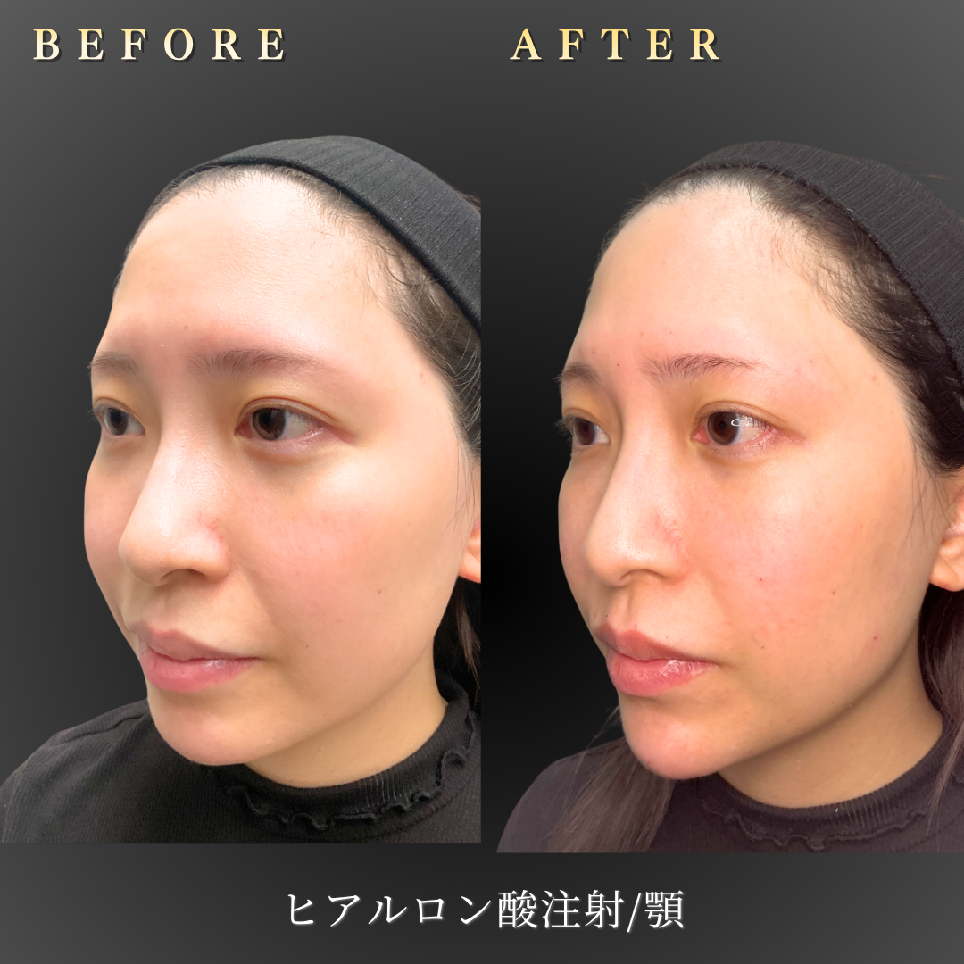 【30代女性】フェイスラインをシャープにする顎ヒアルロン酸症例｜大阪 心斎橋BiBiクリニックの症例写真