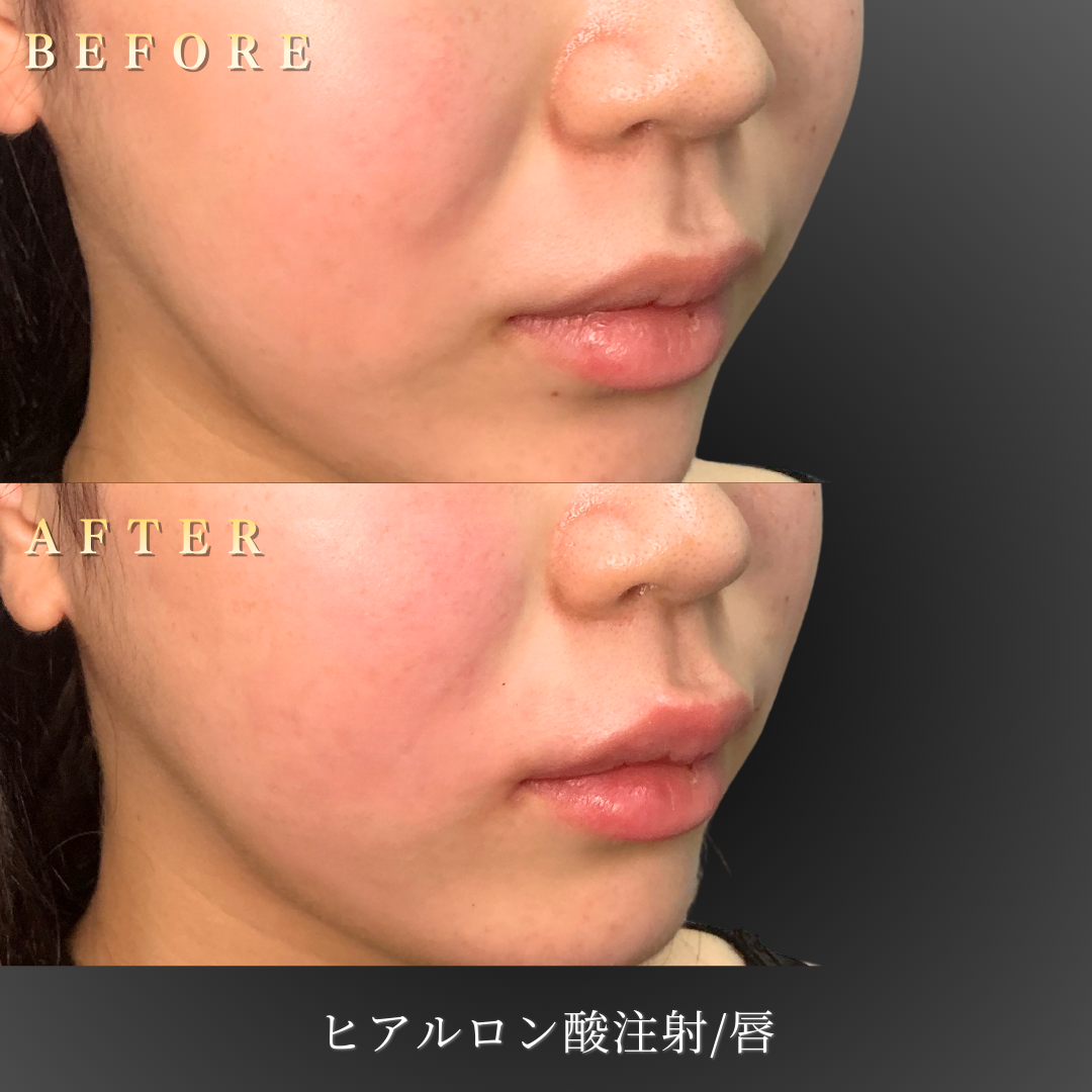 【20代女性】口紅が映える唇を作るリップヒアルロン酸症例｜大阪 心斎橋BiBiクリニックの症例写真