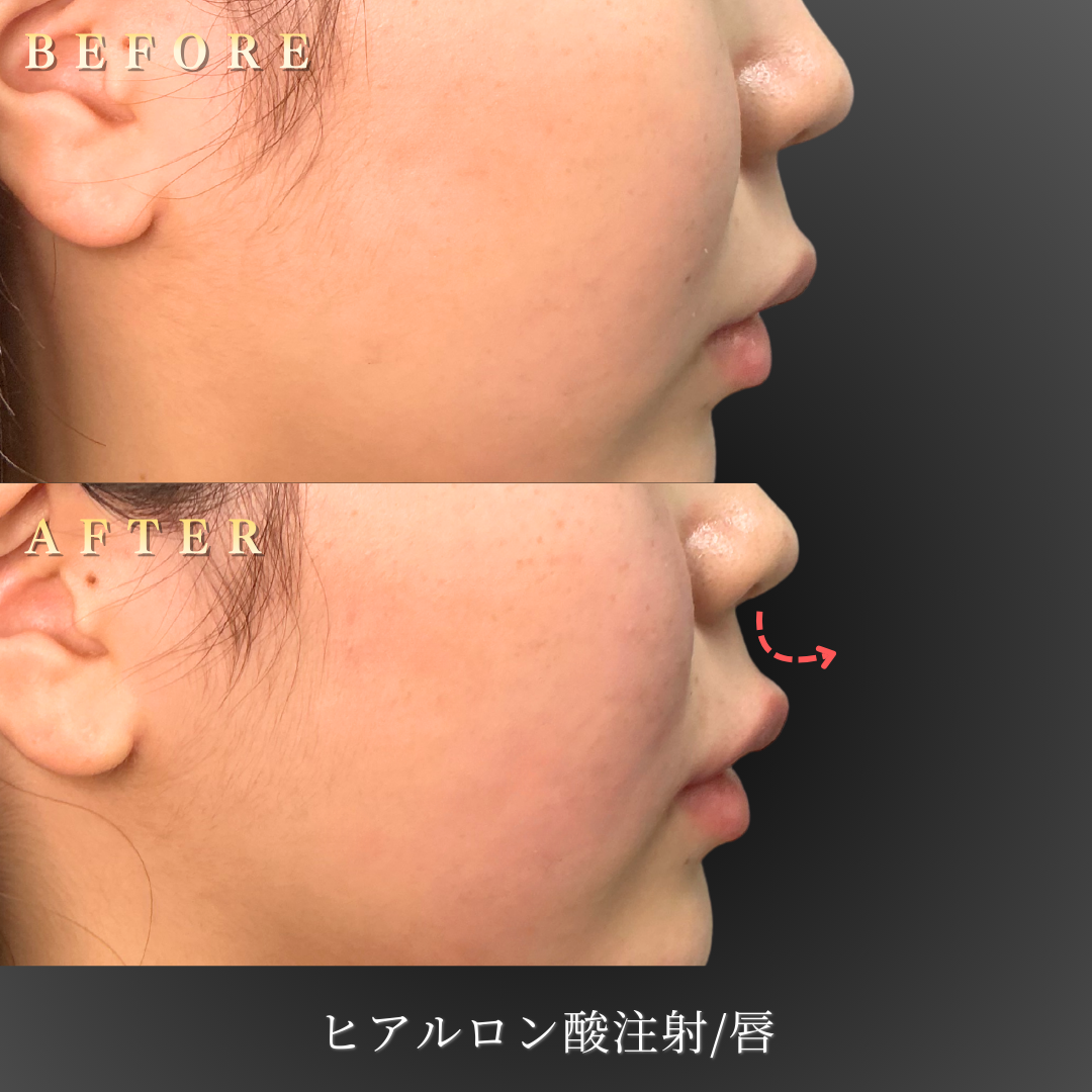 20代女性のリップヒアルロン酸施術後のメイクアップイメージ