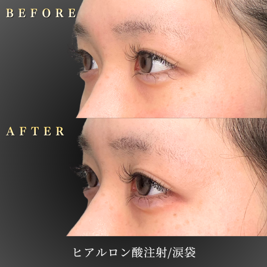 10代女性の涙袋ヒアルロン酸施術のBefore/After左45度写真