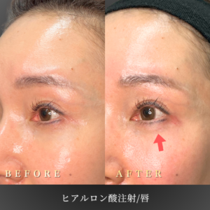 40代 涙袋ヒアルロン酸 症例写真〔左45度Before/After〕｜大阪 心斎橋BiBiクリニック