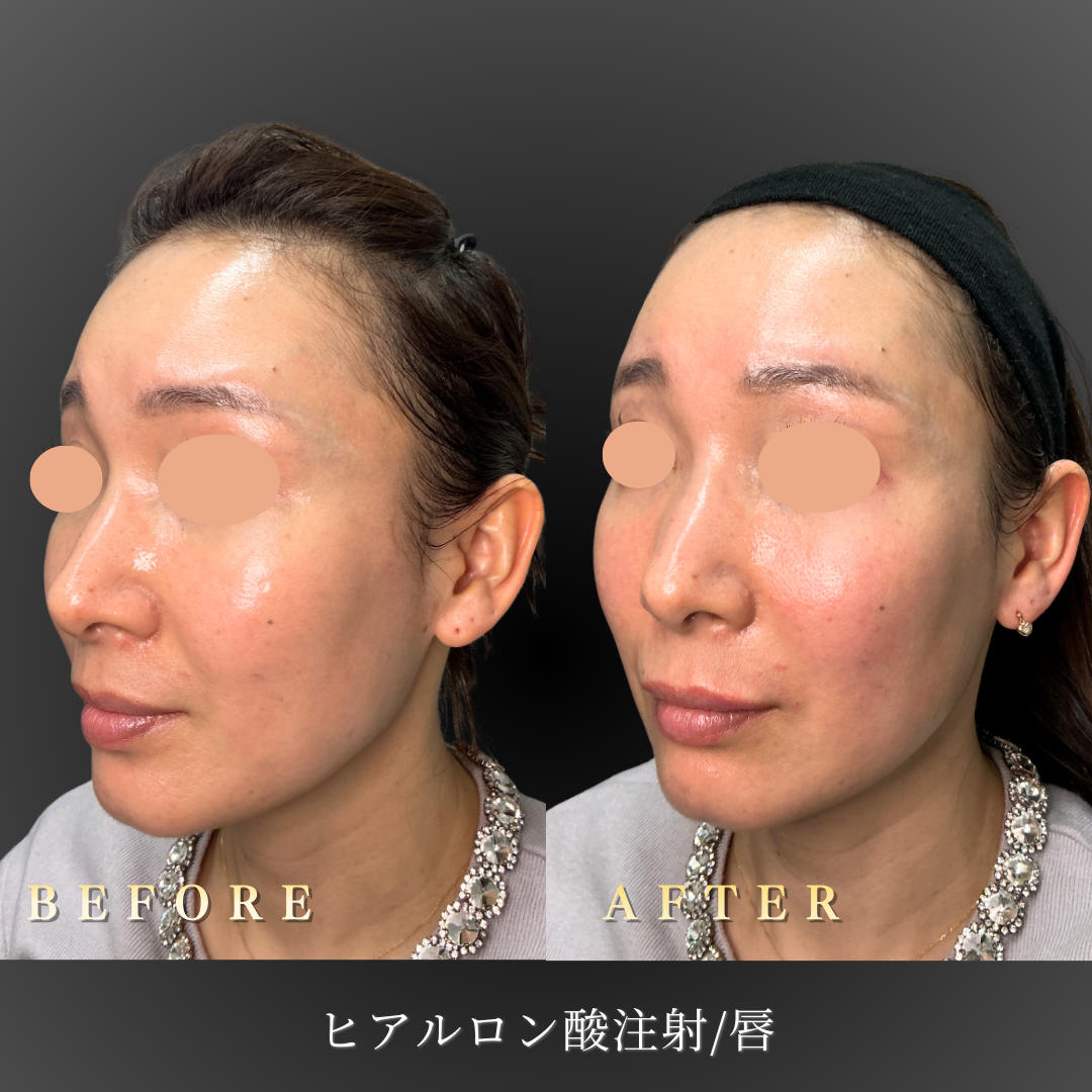 40代女性患者様の唇の状態（治療前）